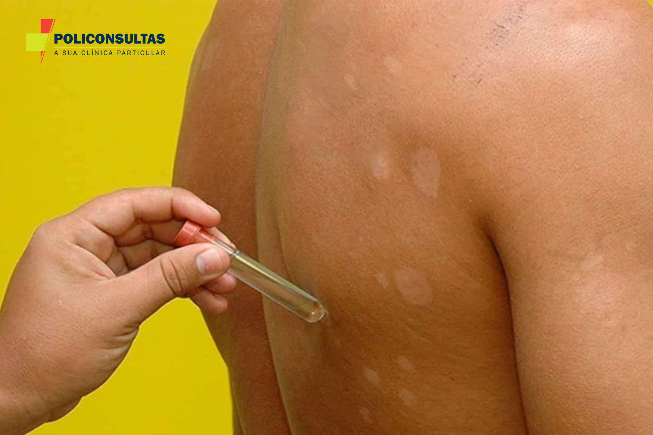 HANSENÍASE SINTOMAS E COMO FICA O CORPO TRANSMISSÃO